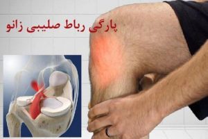 پارگی رباط صلیبی قدامی