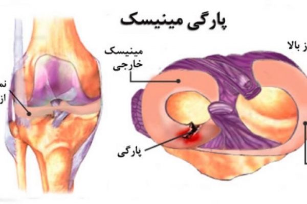 پارگی مینیسک زانو