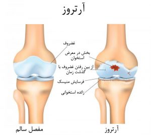 آرتروز زانو