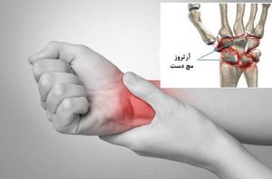 آرتروز مچ دست