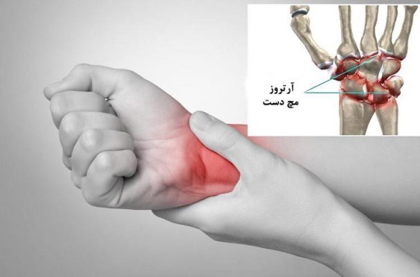 آرتروز مچ دست